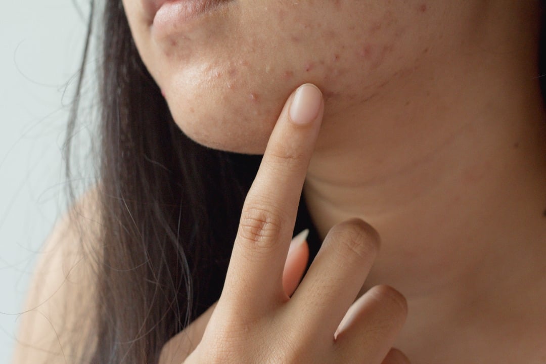 Woman looks in the mirror at the acne on her chin.